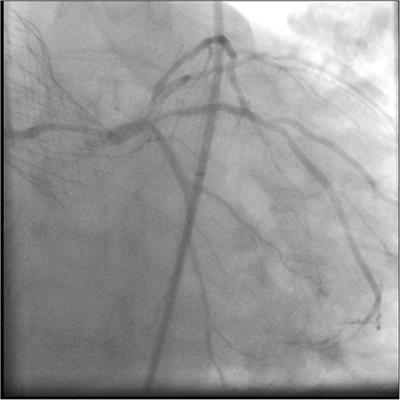 Case Report: Emergency High-Risk Percutaneous Coronary Intervention Following Transcatheter Aortic Valve Implantation in Bicuspid Anatomy